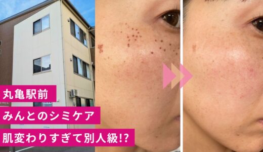 えっ誰!? 『みんと』でシミ取りした人が“肌変わりすぎ”で気づかれなかった話【モニタープランあり】
